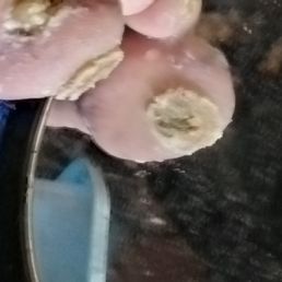 GREAT TOE INFECTION GREAT TOE INFECTION