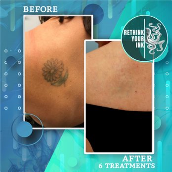 Rethink Your Ink - Check out the results on this Multicolored tattoos! - Tattoo Removal Near Me - Jupiter, Florida Rethink Your Ink - Check out the results on this Multicolored tattoos! - Tattoo Removal Near Me - Jupiter, Florida