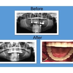 Dental Implant Institute - This patient came to see us and was quite unhappy with her current smile and decided she no longer wanted to spend money on f...