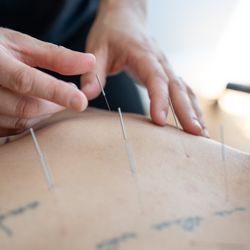 Emerge Holistics - Acupuncture for back pain