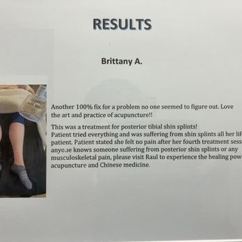 Raul Beltran - Posterior shin splints cured with acupuncture. - Acupuncture Near Me - Shawano, Wisconsin
