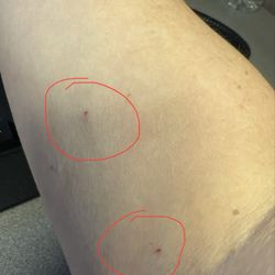 Labcorp - 2 pokes