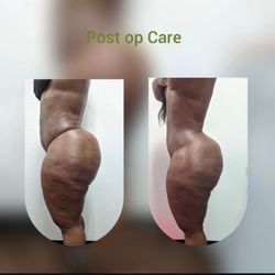Sudden Envy - House call post op lymphatic massage