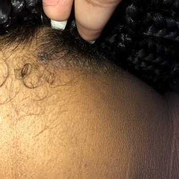 Majestik Braiding - Bumpy skin - Hair Extensions Near Me - Hanover, Maryland Majestik Braiding - Bumpy skin - Hair Extensions Near Me - Hanover, Maryland