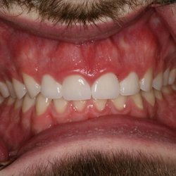 Hope Dental - After orthodontics and crowns on front teeth, this young man now smiles all the time!