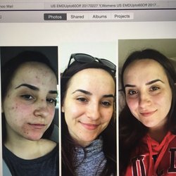 Advanced Skin Care & Permanent MakeUp - Left: the day I went in for my first facial Middle: 1 month after Right: 2-3 months after