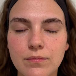 Eden Med Spa - Results 12 days after