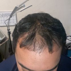 Bosley Hair Restoration & Transplant - It's been a year and six months of my hair transplant From Bosley.