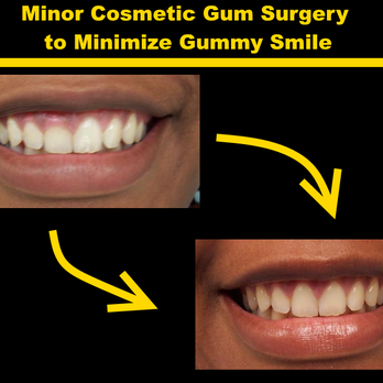 Thomas Torre DMD - Minor Cosmetic Gum Surgery to Minimize Gummy Smile - Dentists Near Me - Nutley, New Jersey Thomas Torre DMD - Minor Cosmetic Gum Surgery to Minimize Gummy Smile - Dentists Near Me - Nutley, New Jersey