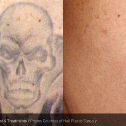 Phoenix Tattoo Removal and Skin Revitalization - PicoSure Tattoo Removal.