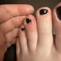 QPI Nails - Infected toe