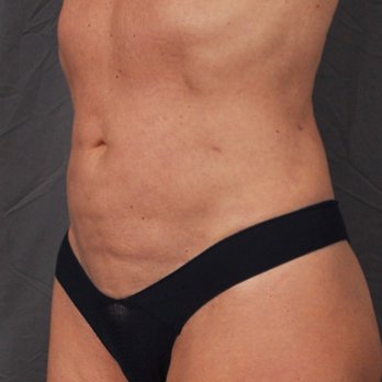 Infini Cosmetic Associates - After - Cosmetic Surgeons Near Me - Scottsdale, Arizona