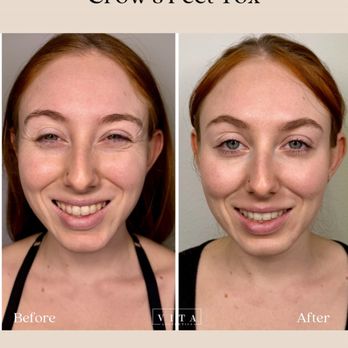 Vita Aesthetics - crows-feet-tox-before-after-vita-aesthetics-sarasota-fl - Medical Spas Near Me - Sarasota, Florida Vita Aesthetics - crows-feet-tox-before-after-vita-aesthetics-sarasota-fl - Medical Spas Near Me - Sarasota, Florida