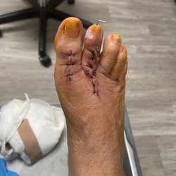 Silver Larry M Podiatrist - Don't have a before picture, but the toe with the pin would lay on top on the big toe. So Dr.Silver did his Magic.