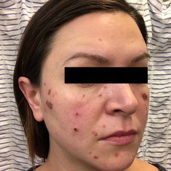 Hoboken Wellness Spa - 2 weeks post treatment. I only asked for treatment on spots under my eyes and on cheekbones. She zapped all over my face. - Day Spas Near Me - Hoboken, New Jersey Hoboken Wellness Spa - 2 weeks post treatment. I only asked for treatment on spots under my eyes and on cheekbones. She zapped all over my face. - Day Spas Near Me - Hoboken, New Jersey