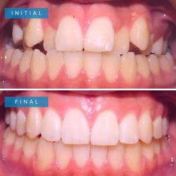 Holliday Orthodontics - Before and after