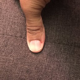 My thumb was injured as well and blood is still visible through the skin.