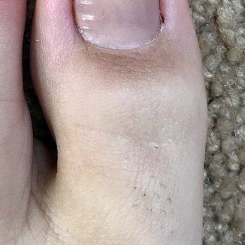 MB Comprehensive Foot & Ankle Specialists - Toe today (12/22/17) I couldn't be happier with how my toe healed. - Podiatrists Near Me - Palmdale, California MB Comprehensive Foot & Ankle Specialists - Toe today (12/22/17) I couldn't be happier with how my toe healed. - Podiatrists Near Me - Palmdale, California