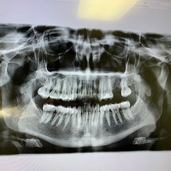 Ventura County Orthodontics - Digital xrays
