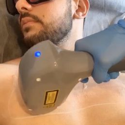 Laser Hair Removal