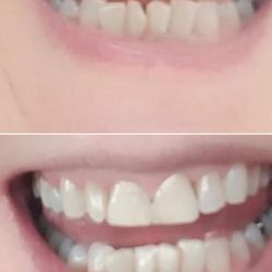 Fred S Maron, DMD - Cracked lower central incisor
FIXED!