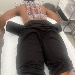 Kim's Acupuncture Clinic - Cupping and Acupuncture on my son his first time .