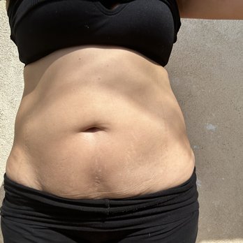 Zenden Body Sculpting - Body Contouring Near Me - Los Angeles, California