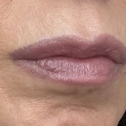 Breazeale Clinic For Plastic Surgery - After Lip Flip