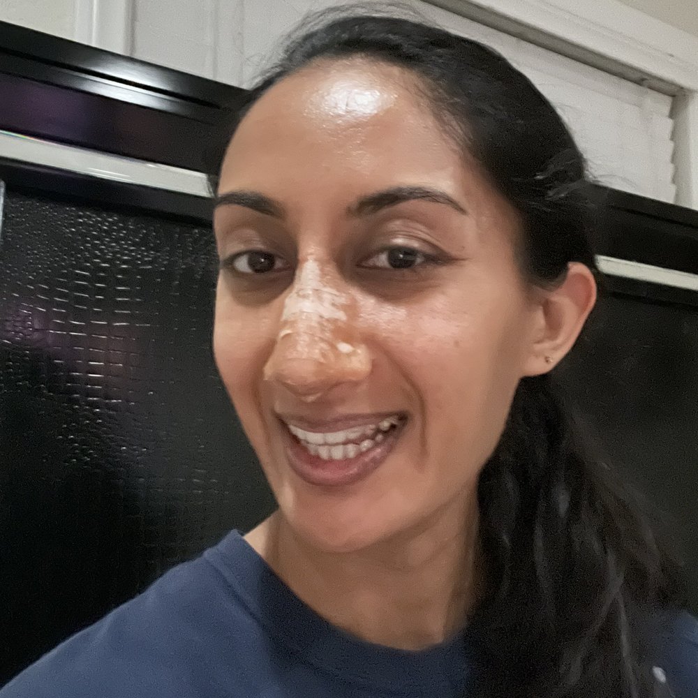 T.Y. Steven Ip, MD - Two weeks after procedure in tape - Cosmetic Surgeons Near Me - Newport Beach, California T.Y. Steven Ip, MD - Two weeks after procedure in tape - Cosmetic Surgeons Near Me - Newport Beach, California