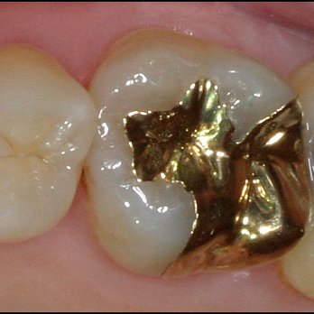 Murphy Sean, DDS - The strength and beauty of gold is unmatched. - General Dentistry Near Me - Gig Harbor, Washington Murphy Sean, DDS - The strength and beauty of gold is unmatched. - General Dentistry Near Me - Gig Harbor, Washington