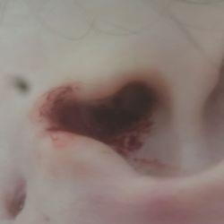 Brunswick Medical Center - The wounds she did by stabbing my ear from her "wax removal".