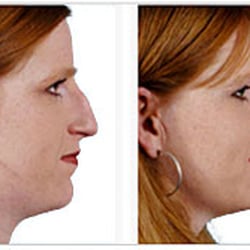 Mobley MD Facial Plastic Surgeon - Rhinoplasty (nose job) Utah