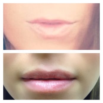 Evolve Medical Associates - Nurse injector Susan gave my tiny top upper lip some volume with lip filler. Love my new pout! Thank You Susan - Skin Care Near Me - Charlotte, North Carolina Evolve Medical Associates - Nurse injector Susan gave my tiny top upper lip some volume with lip filler. Love my new pout! Thank You Susan - Skin Care Near Me - Charlotte, North Carolina