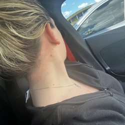 Electrolysis By Zabil - Irritation looks severe, (I'm pale), but downtime is about 2-3 days. I mix aloe & Neosporin on the skin after cleaning it with witch hazel