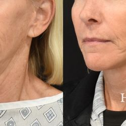 Harmon Facial Plastic Surgery