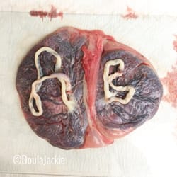 Placenta Encapsulation Twins