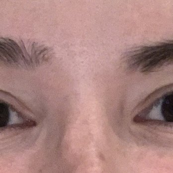 DermFx - After crows feet and under eyes - Medical Spas Near Me - Orange, California