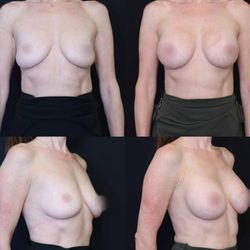 Sieber Plastic Surgery - Breast Augmentation