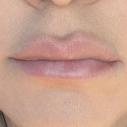 Bella Medspa - After my injection at Bella med spa. Very noticeable asymmetry