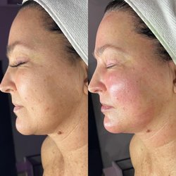 Mad Esthetics - Results from one DMK Level Three- Muscle Banding Enzyme Treatment