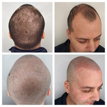 Blowology Dry Bar & Spa Sf - SMP non - invasive treatment - Hair Loss Centers Near Me Blowology Dry Bar & Spa Sf - SMP non - invasive treatment - Hair Loss Centers Near Me
