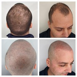 Blowology Dry Bar & Spa Sf - SMP non - invasive treatment
