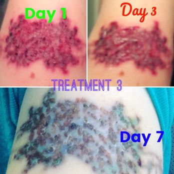 Summit Dermatology - Third tattoo removal treatment - Dermatologists Near Me - Olympia, Washington