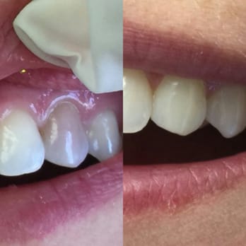 Mahrouz Cohen, DDS - Before and after. You can't even tell! - Endodontists Near Me - Encino, California Mahrouz Cohen, DDS - Before and after. You can't even tell! - Endodontists Near Me - Encino, California