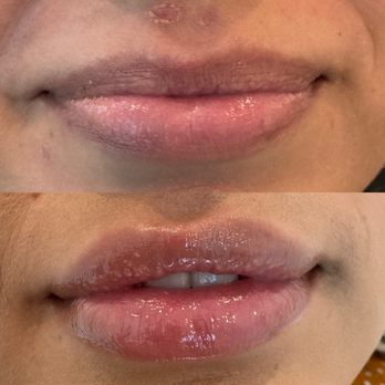Lulu Ortiz MSN, FNP - Lip filler - Medical Spas Near Me - Rancho Cucamonga, California Lulu Ortiz MSN, FNP - Lip filler - Medical Spas Near Me - Rancho Cucamonga, California