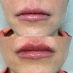 The Laser & Rejuvenation Center - Lip Filler before and after.