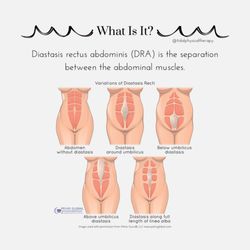 Tidal Physical Therapy - "Do I have Diastasis recti?" I answer this question regularly using a thorough assessment of one's abdomen, strength, and coordination.