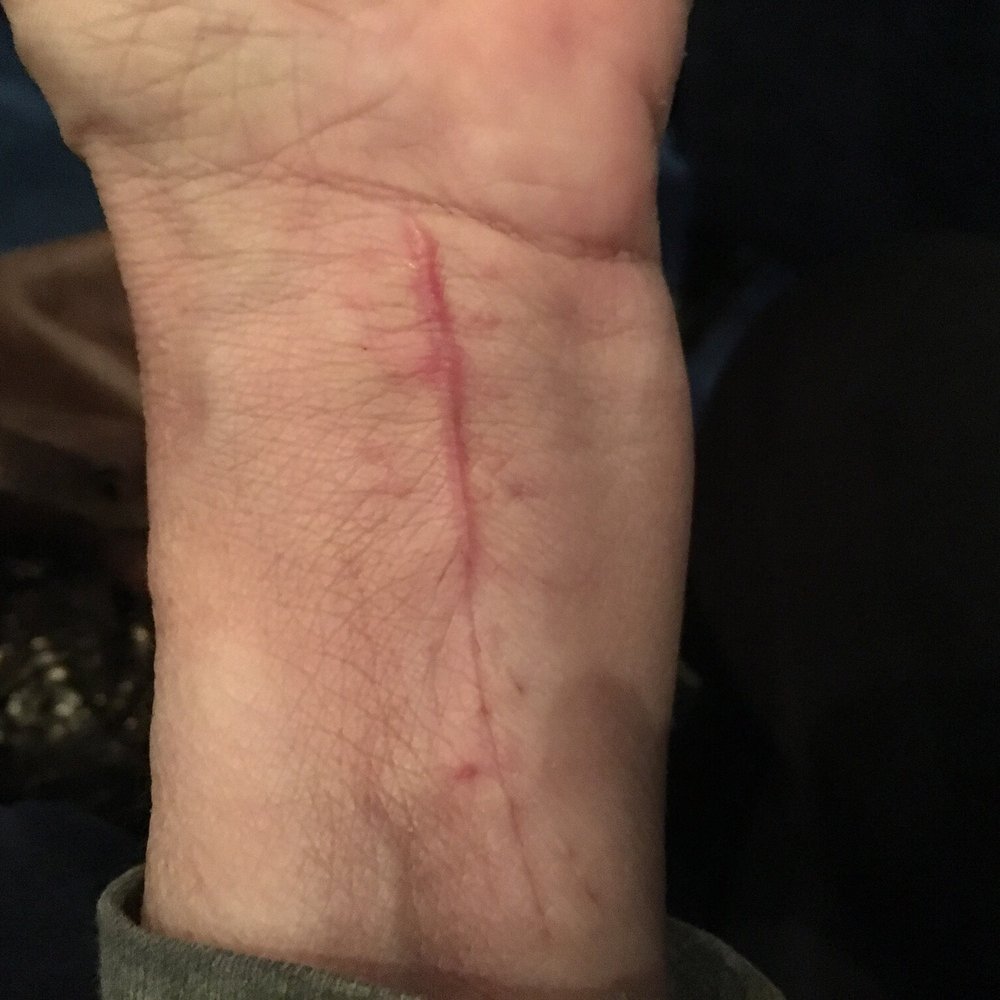 Mercury Insurance - My wrist surgery - Home & Rental Insurance Near Me - Brea, California