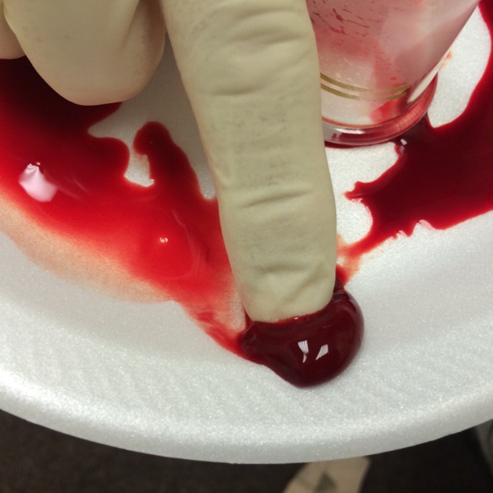 CBDCHIRO Chiropractic & Acupuncture  - This might be too much, but I'm a nerd and wanted to take a picture of the gunk he removed. Dead blood. - Chiropractors Near Me - Houston, Texas