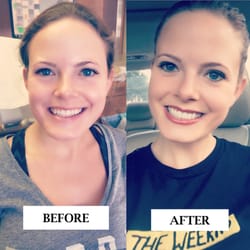 James E Hopper, DDS - Porcelain Veneers before and after.